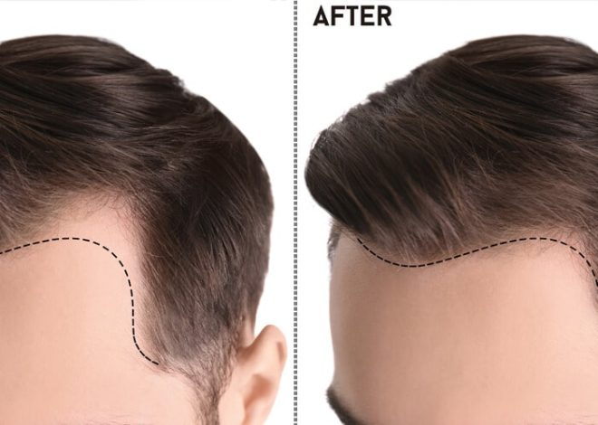 Decoding Excellence: Your Ultimate Guide to Hair Transplant in Islamabad