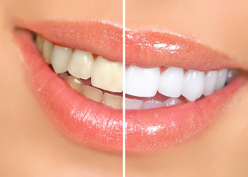 Achieve a Brilliant Smile with Cosmetic Crowns in Woodinville WA