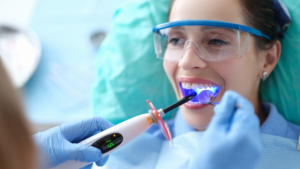 Composite Fillings