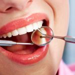 Exploring the Benefits of Teeth Bonding in Fenton, MO