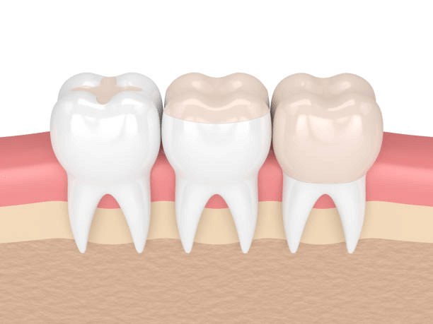 Long Term Benefits of Dental Sealants in Thompsons Station