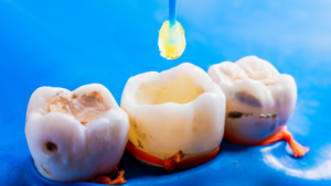 Porcelain Fillings