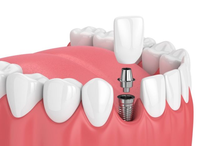 Reclaim Your Confidence with a Single Tooth Implant in Dallas, TX