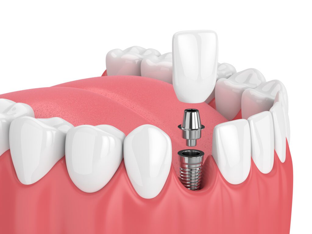 single tooth implant dallas tx