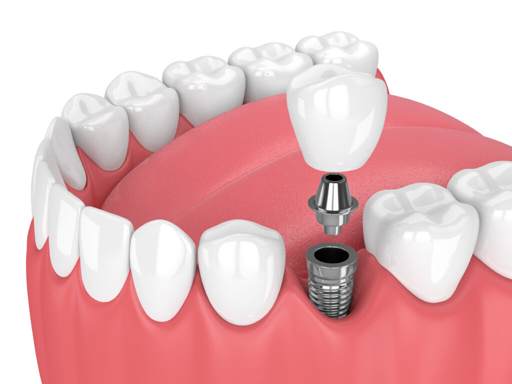 Single Tooth Implant in Tampa, FL: A Permanent Solution for Your Smile