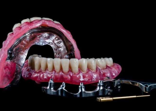 Knowing Houston All-on-4 Implants and TMJ