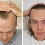 FUE Hair Transplant in the UK: Top Clinics, Prices, and What to Expect in London