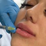 Enhancing Your Beauty: Lip and Cheek Enhancement in Pell City, AL