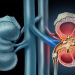 How Can We Approach the Kidney Stone Robotic Surgery Treatment?