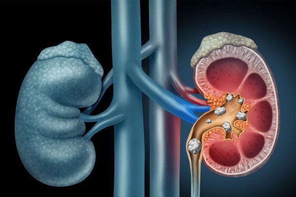 How Can We Approach the Kidney Stone Robotic Surgery Treatment?