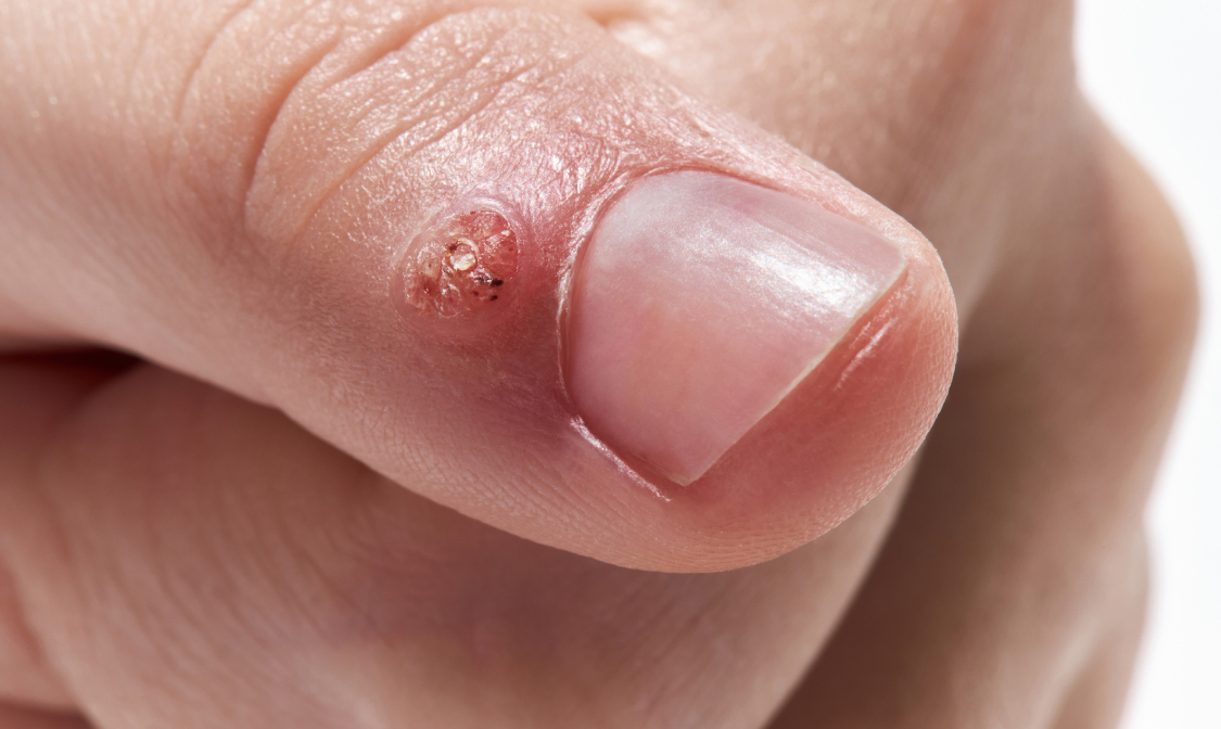 wart removal treatment