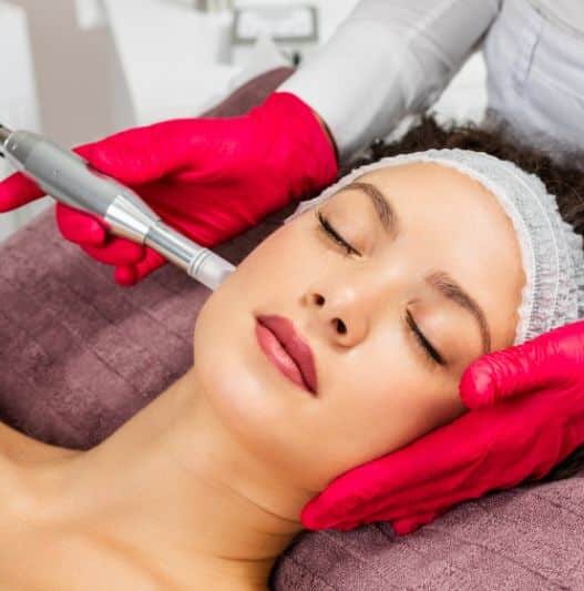 MicroNeedling Southampton