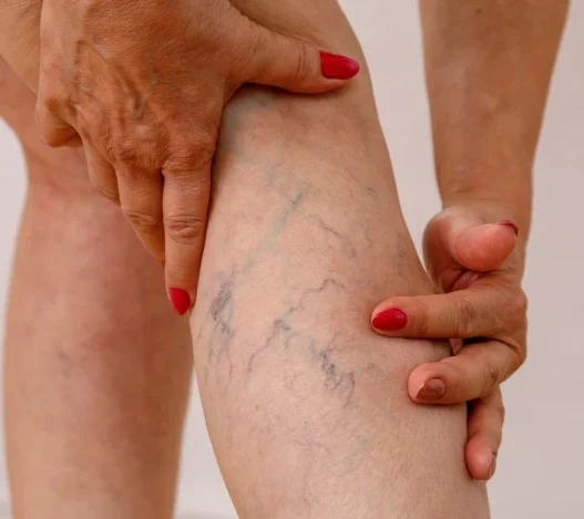 Varicose Veins