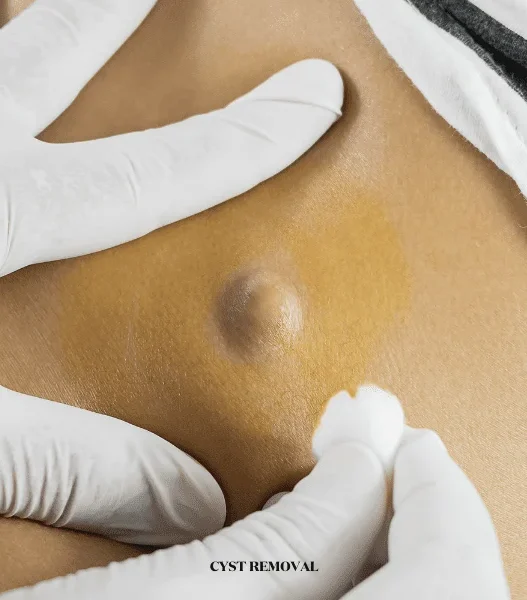 Why London Residents Are Choosing Professional Cyst Removal