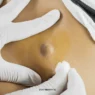 Why London Residents Are Choosing Professional Cyst Removal