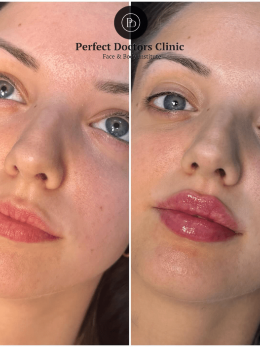 Juvederm