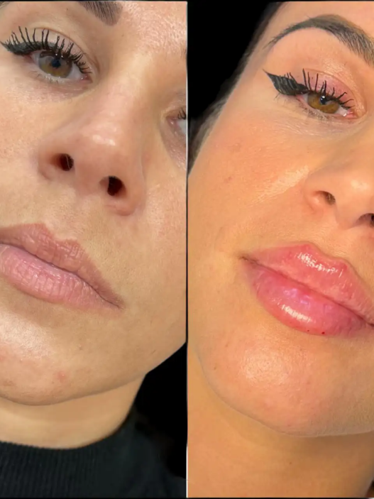 Juvederm