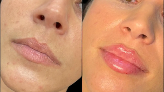 Juvederm