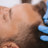 Hair Transplant Cost