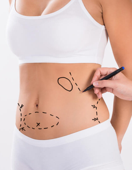 Liposuction Surgery in Dubai