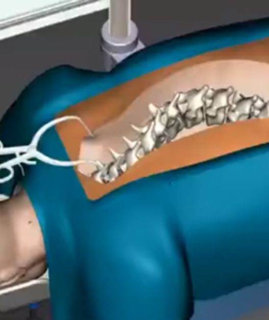 Risks and Benefits Spine Surgery vs. Conservative Treatment