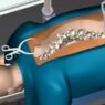 Risks and Benefits Spine Surgery vs. Conservative Treatment