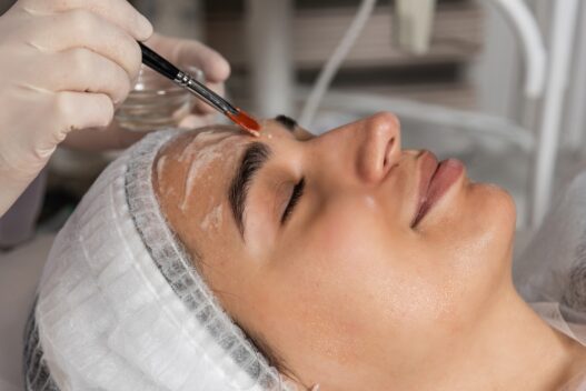 chemical peel treatment