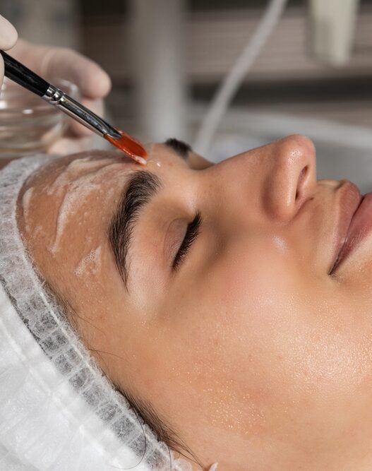 chemical peel treatment