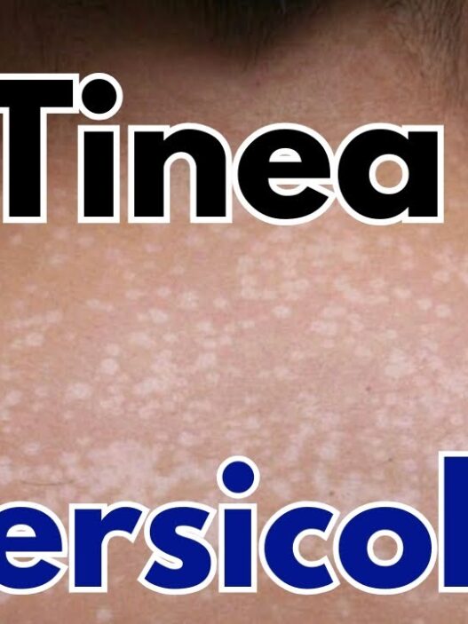 home remedies for Tinea Versicolor 3