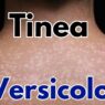 home remedies for Tinea Versicolor 3