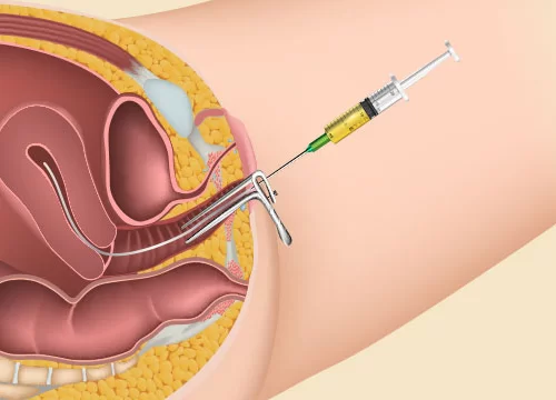 IUI Procedure