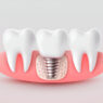 Dental Implant Specialists in Aberdeen