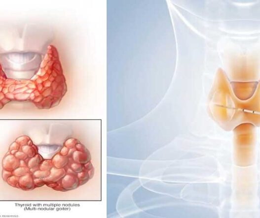 thyroid nodules