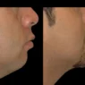 Double chin removal