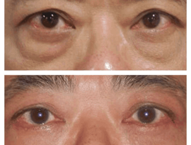 Eye Bag Removal