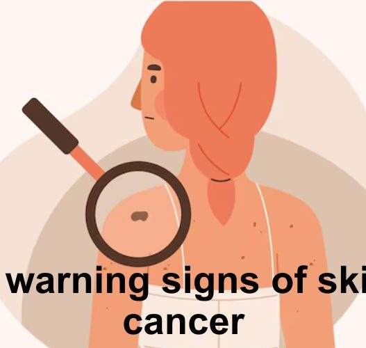 Skin cancer is one of the most common types of cancer, with millions of cases diagnosed worldwide each year.