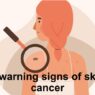 Skin cancer is one of the most common types of cancer, with millions of cases diagnosed worldwide each year.