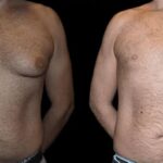 gynecomastia in dubai