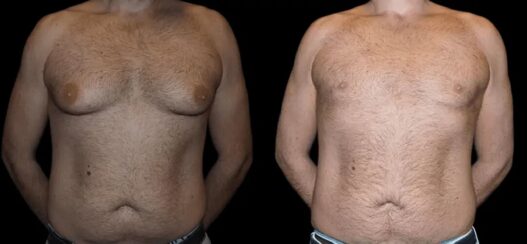 gynecomastia in dubai