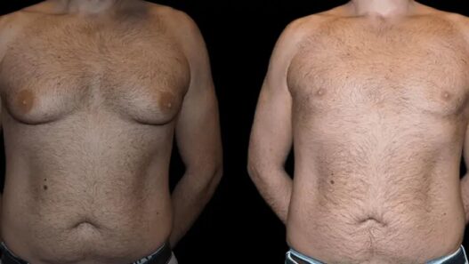 gynecomastia in dubai