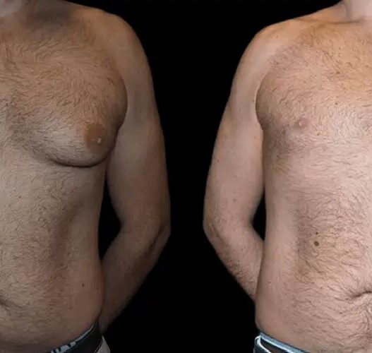 gynecomastia in dubai