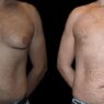 gynecomastia in dubai