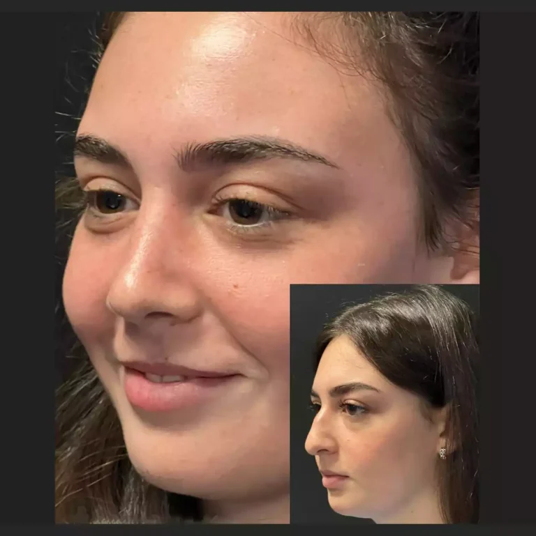 Septoplasty in Dubai: Fixing Deviated Nasal Septums