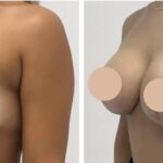 breast lift in dubai