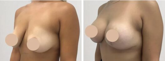 breast lift in dubai