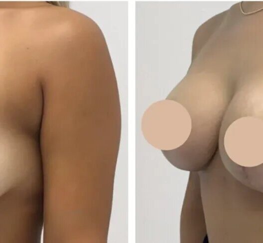 breast lift in dubai