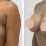 breast lift in dubai