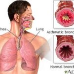 Inhaler with medicine for asthma relief