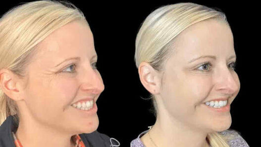Experience the Best Doctors in Dubai for Botox Rejuvenation