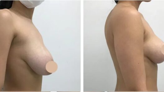 breast lift in dubai